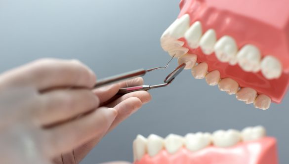 Implant Tedavisi: Kaybedilen Dişler İçin Kalıcı Çözüm