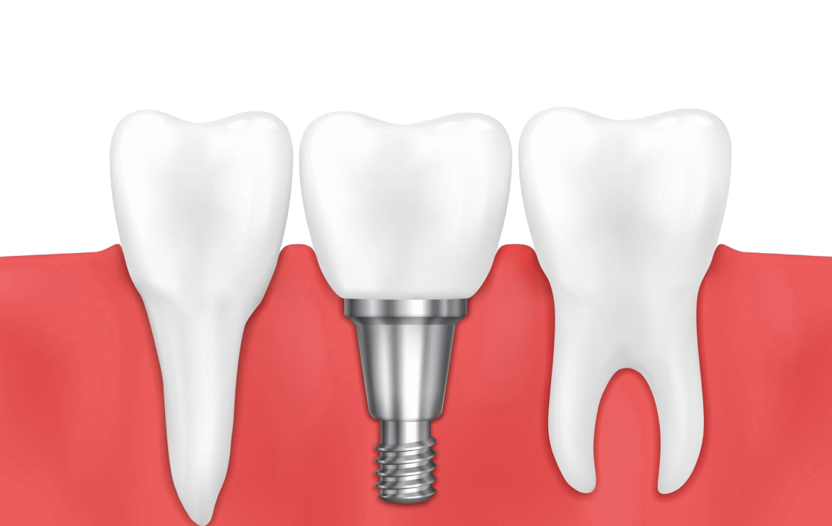 Implant Diş Silivri