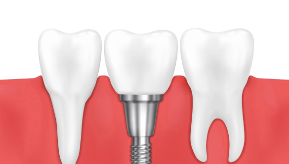 Implant Diş Silivri