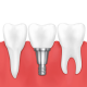 Implant Diş Silivri